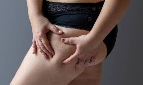 4 Reasons to Receive Cellulite Treatment