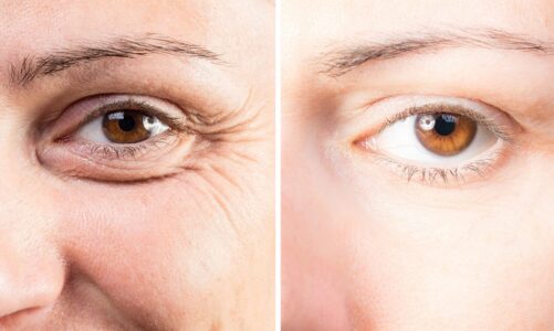 Reviving Your Lost Vision With The Help Of Droopy Eyelid Surgery