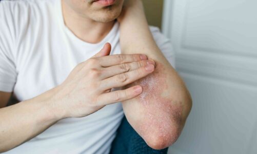 Irritated With Itchy Rashes? Use These Tips To Keep Them Away